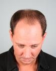 Before Hair Transplant&nbsp;Midscalp